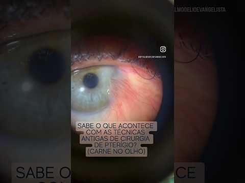 Sabe o q acontece com as técnicas antigas da cirurgia de Pterígio? #pterigio #olhovermelho