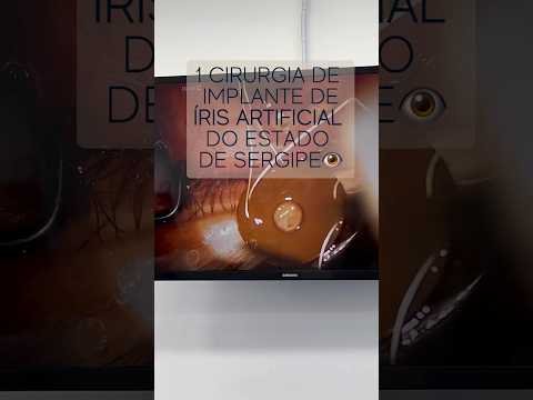 Realizei a primeira cirurgia de implante de Íris Artificial do estado de Sergipe #irisartificial