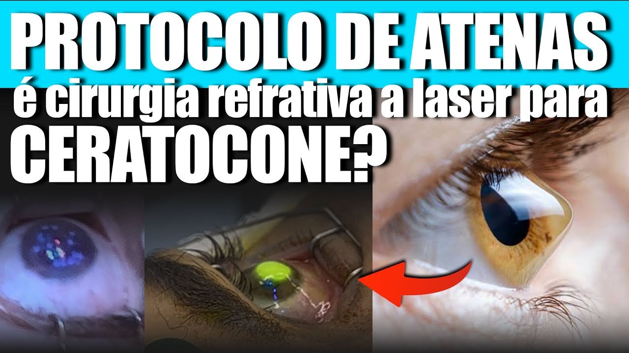 Protocolo de Atenas: Cirurgia Refrativa para Quem Tem Ceratocone?