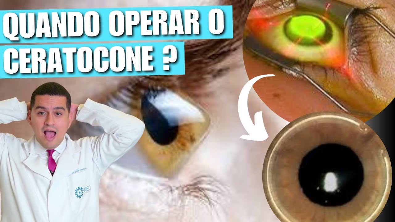 Quando é Necessário Fazer Cirurgia para Ceratocone?