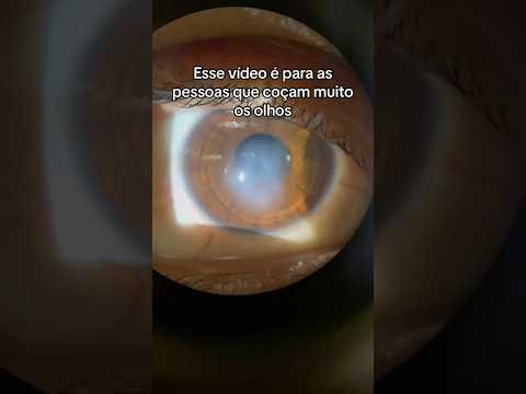 O perigo de coçar os olhos 👀
