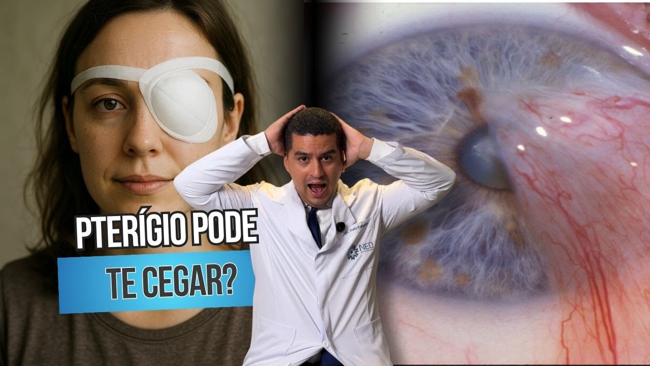 Pterígio pode causar cegueira? Entenda os riscos da “carne no olho”