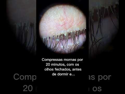 Caspa no cílios: é normal?