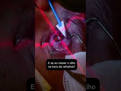 Cirurgia refrativa: mexi o olho na cirurgia e agora?